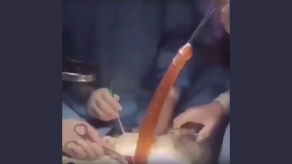 A giant parasite resembling a penis extracted from a woman's abdomen