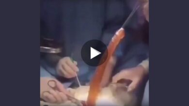 A giant parasite resembling a penis extracted from a woman's abdomen